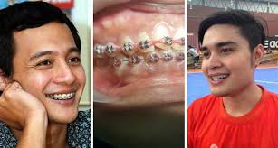 Prosedur braces bergantung kepada cadangan yang disyorkan oleh doktor gigi. Gigi Berselerak Pakailah Braces Baru Gigi Rata Semula Maskulin