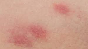 For the most part, you can't tell a spider bit you just from your symptoms. Bites And Stings Pictures Causes And Symptoms