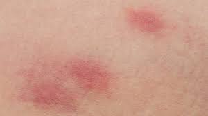 They're pretty much just like an insect bite. Bites And Stings Pictures Causes And Symptoms