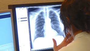 Finding these cancers in people without symptoms is rare and usually accidental (while doing tests to check for other medical problems). Lung Cancer Symptoms Signs Stages And More