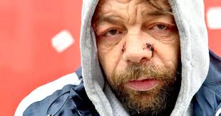 Someone tried to bite my nose off' Life bereft of hope homeless