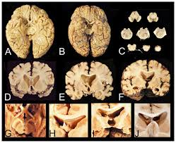 Computed tomography enterography, medical imaging technique. Gross Neuropathological Features Of Advanced Chronic Traumatic Download Scientific Diagram