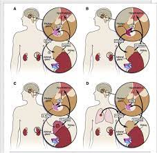 Exogenous Cushing S Syndrome Secondary To Intermittent High Dose Oral Prednisone For Presumed Asthma Exacerbations In The Setting Of Multiple Emergency Department Visits Sciencedirect