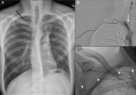 • peripherally inserted catheter that tip is not centrally placed, such as a groshong • may remain in for 30 days • determine by measurement of line or cxr • indications for use: Spontaneous Coiling Of A Peripherally Inserted Central Venous Catheter Bmj Case Reports