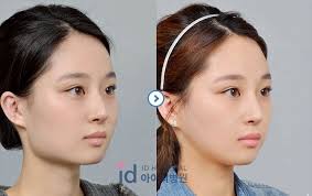In south korea (hereafter “korea”) in particular, an increasing number of people have been undergoing cosmetic surgery. Top 8 Plastic Surgery Procedures In Korea Quietly
