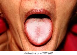 Un Cierre De Una Lengua Enferma Foto De Stock Editar Ahora 1671064615