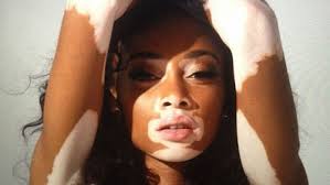 Fino al 2% della popolazione soffre di vitiligine. Vitiligine Le Macchie Si Cancellano Con L Autotrapianto Rapido Ok Salute