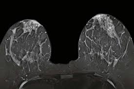 When cancer is suspected, imaging techniques reveal accurate details of tumours, increasing the chances of successful treatment; Breast Mri Found To Result In More Biopsies Than Mammography Health Data Management