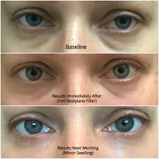 Softer cosmetic fillers offer a lot of versatility for issues under the eyes, from hollowness, deep tear troughs, and even slight under eye bags. Cuisine Friend Gather Cosmetic Treatment For Eye Bags Fotoatelier Birte Fischer Com
