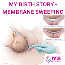 MY BIRTH STORY - MEMBRANE SWEEPING My expected date of delivery (Edd) was  26th July 2023. Per the ANC policy at my hospital, a pregnant woman is  supposed to have her membranes