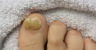 nagel fingernagelpilz erste anzeichen ansteckung behandlung