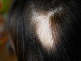 Straight hair parts can enhance the appearance of thinning hair. Hair Loss And Thinning Hair In Women