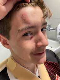 Hi guys. No Finn tomorrow for training, he's broken his fingers 😫 we've  got fracture clinic next week so hoping he'll only be out for week or two.  He's gutted 😞