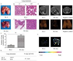Histologic subtyping of epithelioid mesothelioma. Establishment Of A Highly Metastatic Model With A Newly Isolated Lung Adenocarcinoma Cell Line