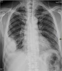 Obtuse Angle With Chest Wall Extra Pulmonary Mass Radiology Human Body Anatomy Radiography