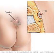 4.5 out of 5 stars. Pilonidal Cyst Symptoms And Causes Mayo Clinic