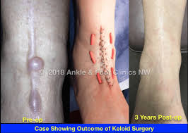 Image result for Keloid