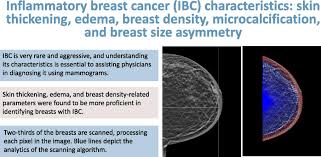 Image result for Inflammatory breast cancer