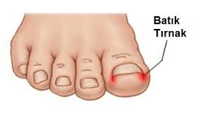 Tirnak Batmasi Batik Tirnak Op Dr Okyar Altas