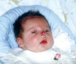 Nació con abultada nariz que crecía sin detenerse