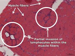 Image result for Polymyositis