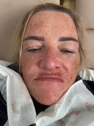 Vegas follow-up and redo in a week, nervous about explaining