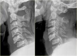 Visit www.orthofilms.com for more videos and info. The Radiology Assistant Cervical Injury