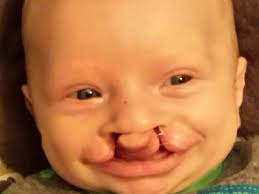 Fundraiser by Bob Lindsey : Mortys Cleft Lip/Palate Surgeries
