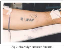We did not find results for: Surgical Management Of Tattoos
