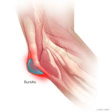 Elbow extension is simply bringing the forearm back to anatomical position.11 this action is performed by triceps brachii with a negligible assistance from anconeus. Elbow Bursitis Mayo Clinic Orthopedics Sports Medicine