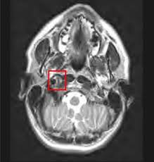 Ehlers Danlos Syndrome Presenting As Severe Headache In A Young Adult Sciencedirect