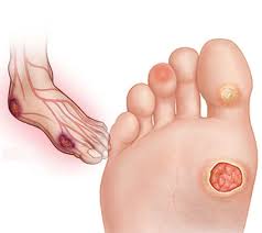 Diyabetik Ayak Op Dr Arif Yavuz Aksoy Genel Cerrahi Uzmani