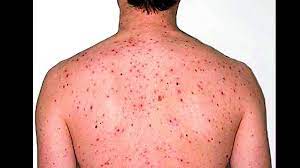 This is the first time the. First Case Of Rare Monkeypox Virus Reported In Singapore