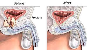 Pin On Prostate Cancer Awareness