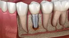 What is The Cost of a Single Tooth Implant? | Omega Dental
