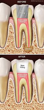 Having a root canal instead of an artificial tooth implant is considered as a better choice because dental implant is a complex procedure in which your whole tooth with root is pulled out and then it is filled with a metallic. Root Canal Retreatment Appleton Wi Dentist Dental Center The Valley Ltd