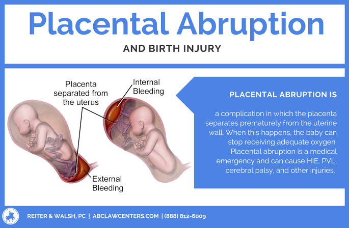 Mga resulta ng larawan para sa Placenta Abruptio"