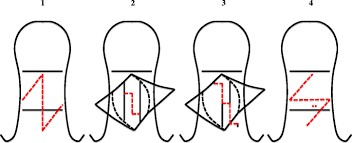 Mladick ra, horton ce, adamson je, cohen bi. Combined Cutaneous Z Plasty And Z Tenotomy For Correction Of Claw Toe Deformity Springerlink