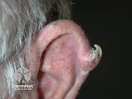 Image result for cornu cutaneum)