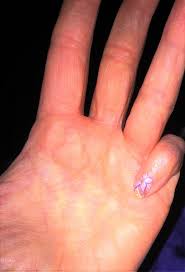 But see a gp if the pain does not improve. Dupuytren Contracture Medlineplus Genetics