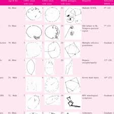 / moca scoring nuances with clock draw a brief screening tool for mild cognitive impairment. Psychometric Characteristics Of The Montreal Cognitive Assessment Download Table