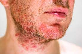 Got Razor Rashes? Here's What Causing Razor Burns And How To Heal Them  Effectively