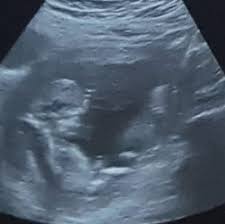 Lasst mir gerne ein abo da. Ultraschallbilder Mehr Als 50 Bilder Aus Der Schwangerschaft Faminino