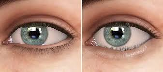 Image result for Entropion