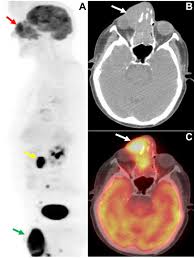 A hybrid device that includes a single patient table for acquiring a pet scan and ct scan ➢ lobular carcinoma of the breast. Pet Ct And Pet Mri In Ophthalmic Oncology Review