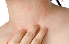 If a patient comes in with red, scaling skin on his face and scalp, a doctor may determine after close inspection. 7 Best Natural Remedies For Eczema Prevention