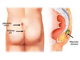 This is the cleft between the buttocks just below the base of the spine. Pilonidal Sinus Colorectal Surgeons Sydney