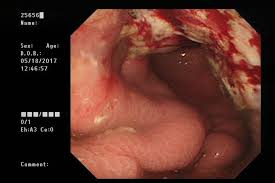 胃癌（いがん、英：stomach cancer または gastric cancer）は、胃に生じる上皮性悪性腫瘍・癌の総称。初期の症状には、胸やけ、上腹部の痛み、吐き気、食欲不振などがある。進行すると、体重減少、嘔吐、嚥下困難、下血などの症状が出現する。 å¥¹ä»¥ç‚ºè²§è¡€è£œéµå°±å¥½åŠå¹´å¾Œç«Ÿå·²ç™Œæœ« èƒƒç™Œ ç™Œç—‡ å…ƒæ°£ç¶²