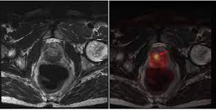 If prostate cancer has been found, mri can be done to help determine the extent (stage) of the cancer. The Role Of Psma Pet Ct And Pet Mri In Diagnosing Prostate Carcinoma Military Medicine Worldwide