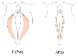 My hubby looked again and said that it looks like an ingrown hair or maybe even a bug bite. Enlarged Labia Causes Symptoms Treatments Labial Hypertrophy